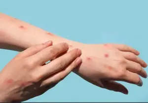 Monkeypox