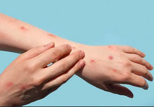 monkeypox